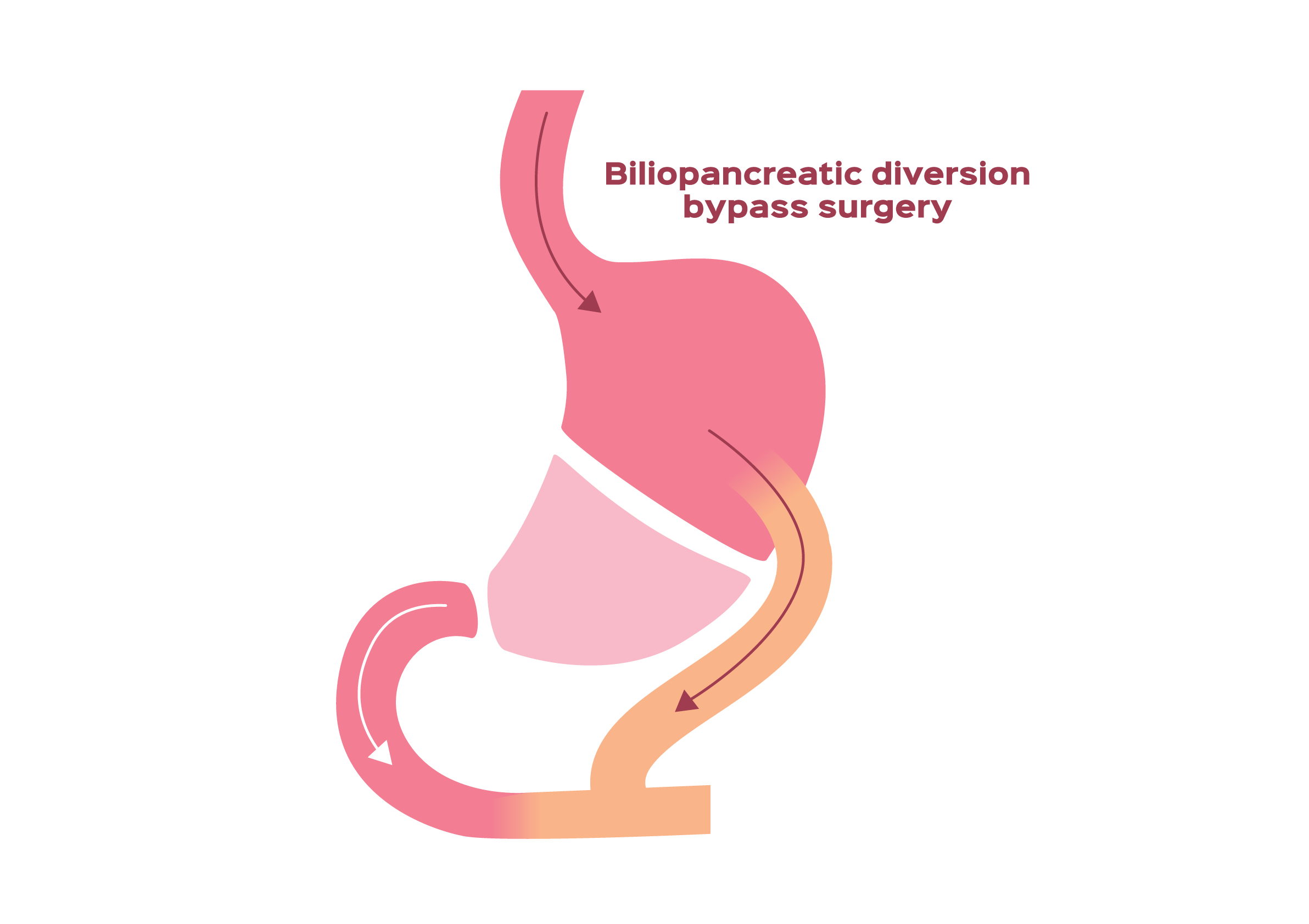 Illustration of how a person's stomach and small intestine are altered during a biliopancreatic diversion bybass surgery.